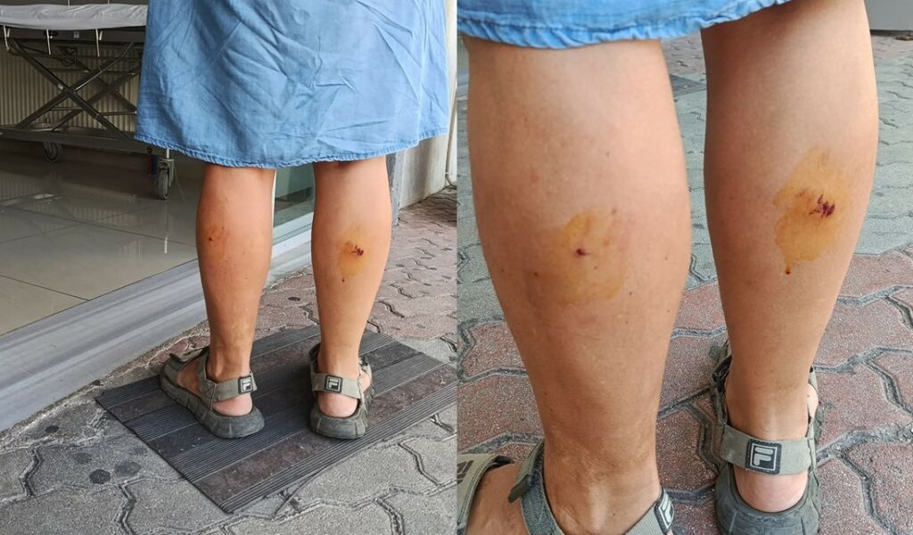 Shtetasja polake “Sapo më kafshoi një qen endacak në shëtitoren e Sarandës